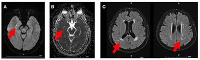 The Significance of Atrial Fibrillation in Patients With Transient Global Amnesia